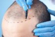 Ultimate Guide to Turkey Hair Transplant Why It's the Top Choice for Hair Restoration