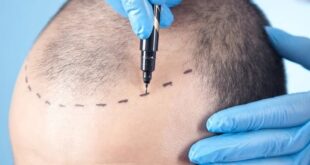 Ultimate Guide to Turkey Hair Transplant Why It's the Top Choice for Hair Restoration