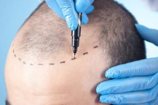 Ultimate Guide to Turkey Hair Transplant Why It's the Top Choice for Hair Restoration