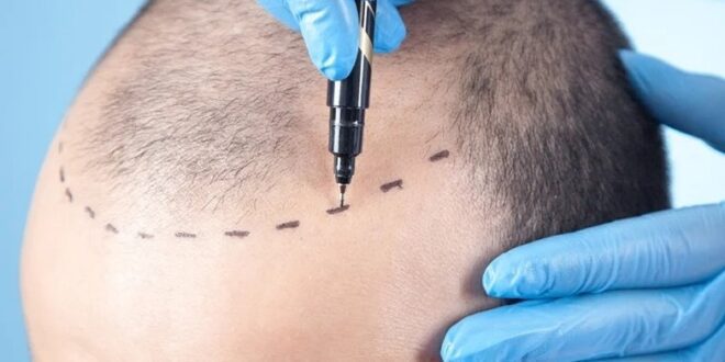 Ultimate Guide to Turkey Hair Transplant Why It's the Top Choice for Hair Restoration